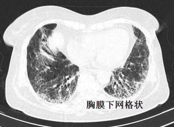 间质性肺病