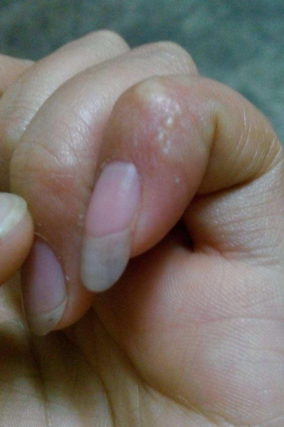 水疱