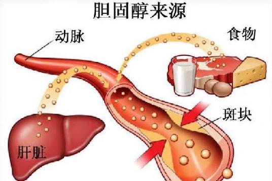 胆固醇高