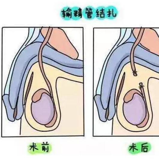 男人结扎